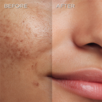 Before and after comparison of skin treatment on a person's face.